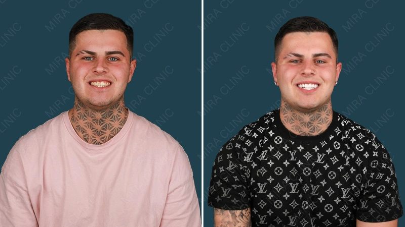 Hollywood smile before after